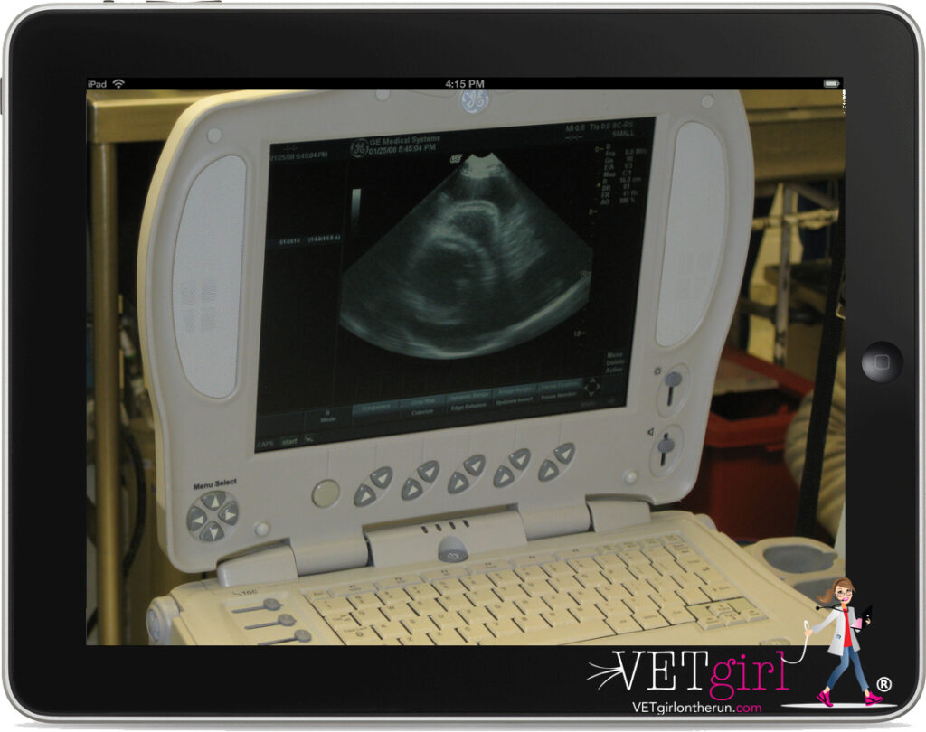Image of pericardial effusion on ultrasound